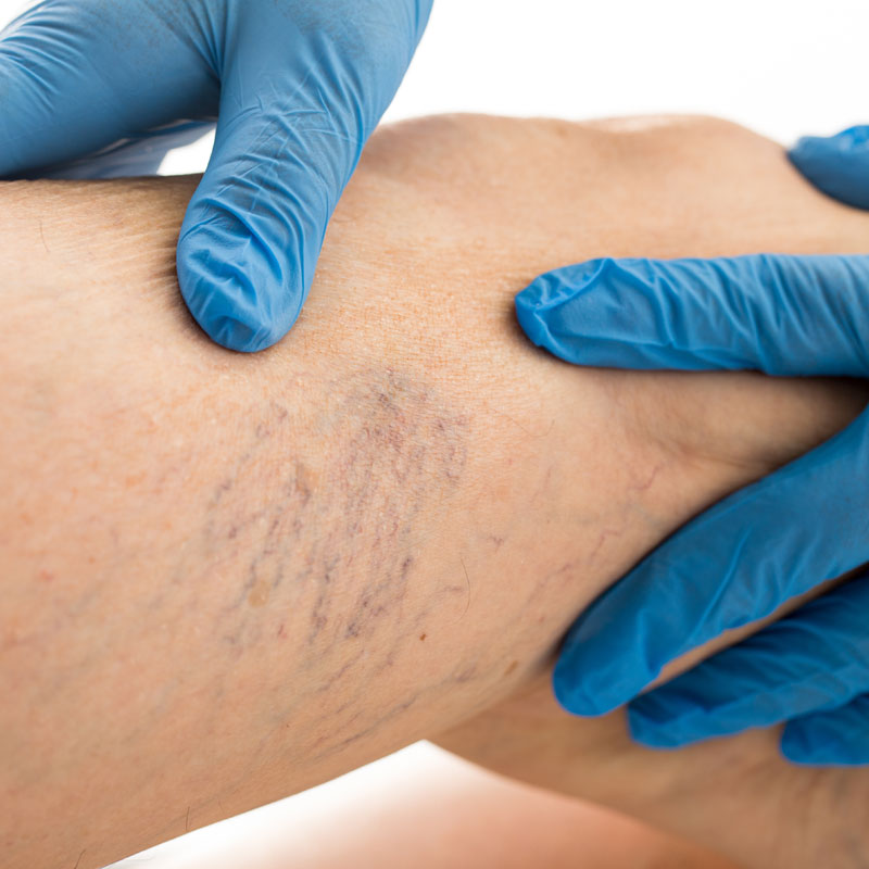 A forearm that reveals varicose veins, dark blue veins