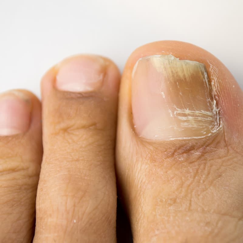 A patient with a toenail that appears cracked and diseased.